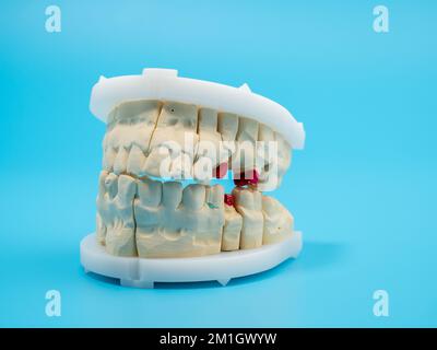 Getti dentali su sfondo blu. Modello di denti in gesso. Primo piano. Foto Stock