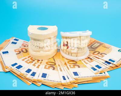 Calchi dentali e banconote su sfondo blu. Modello di denti in gesso. Primo piano. Foto Stock