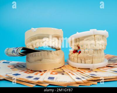 Calchi dentali e banconote su sfondo blu. Modello di denti in gesso. Primo piano. Foto Stock