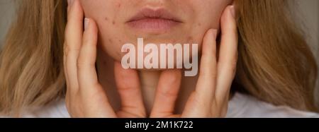 Donna irriconoscibile che mostra la sua acne sulla faccia. Acne di primo piano sul viso della donna con pelle rash, cicatrice e spot che allergico ai cosmetici. Banner problema skincare e concetto di salute. Rughe, melasma, macchie scure, lentiggini, pelle secca, i blackheads dell'acne sulla faccia le donne di mezza età problema dell'acne del mento. pimples sulla pelle di problema di barba. in una ragazza giovane. il disequilibrio ormonale. I disturbi della pelle portano alla depressione e alle insicurezze nelle donne Foto Stock