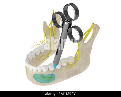 Arco mandibolare con blocco nervoso incisivo. Tipi di anestesia dentale concetto. Foto Stock