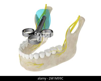 3d rappresentazione dell'arco mandibolare con blocco nervoso delle gole. Tipi di anestesia dentale concetto. Foto Stock