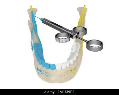 3d rappresentazione dell'arco mandibolare con blocco nervoso delle gole. Tipi di anestesia dentale concetto. Foto Stock