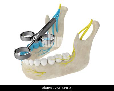 3d rappresentazione dell'arco mandibolare con blocco nervoso delle gole. Tipi di anestesia dentale concetto. Foto Stock