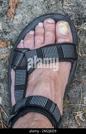 Piede in sandalo che mostra Onychomicosis / tinea unguium, infezione fungina di unghia del piede / unghia del piede | Pied dans sandale montrant onychomycose / mycose de l'ongle du gros orteil 24/08/2018 Foto Stock