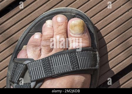 Piede in sandalo che mostra Onychomicosis / tinea unguium, infezione fungina di unghia del piede / unghia del piede | Pied dans sandale montrant onychomycose / mycose de l'ongle du gros orteil 24/08/2018 Foto Stock