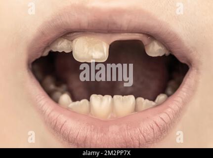 Primo piano dei dentini del bambino malsani. Il bambino paziente a bocca aperta mostra cavità decadimento dei denti Foto Stock