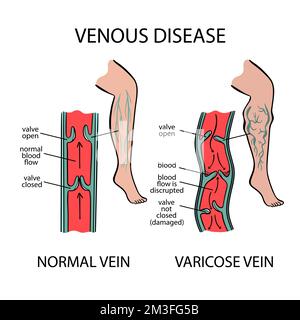 VENE VARICOSE malattia venosa delle gambe umane torsione e dilatazione dei vasi sanguigni rappresentazione schematica dei cambiamenti nelle parti del corpo per educazione medica Illustrazione Vettoriale