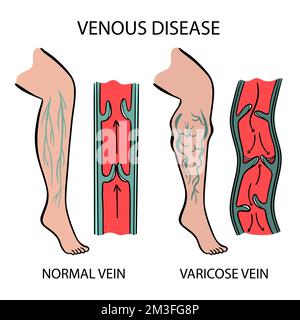 MALATTIA VENOSA vene varicose delle gambe umane torsione e dilatazione dei vasi sanguigni rappresentazione schematica dei cambiamenti nelle parti del corpo per educazione medica Illustrazione Vettoriale