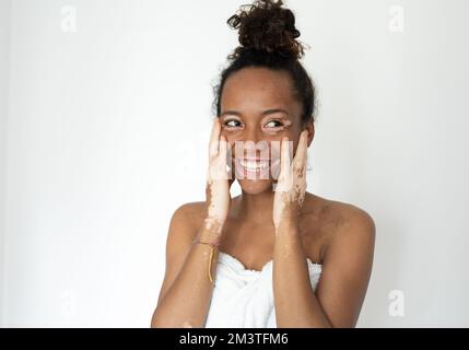 Bella giovane donna brasiliana con vitiligo posando con asciugamano, cura della pelle e concetti genetici di pigmentazione, gente sorridente e concetto positivo del corpo Foto Stock