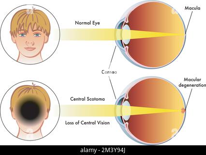 Illustrazione medica confrontare un occhio umano con scotoma centrale, con occhio normale. Illustrazione Vettoriale