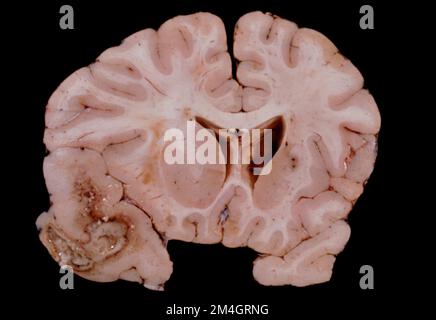 Sezione coronale attraverso un cervello umano a livello di talamo che mostra un grande ascesso, probabilmente di origine batterica, situato nel lobo temporale. Il g Foto Stock