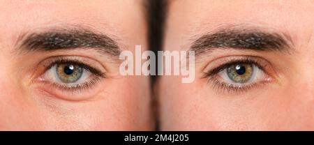 Occhi della donna con e senza sacca per gli occhi prima e dopo il trattamento cosmetico. Concetto di blefaroplastica, rimozione delle rughe e gonfiore sotto gli occhi Foto Stock