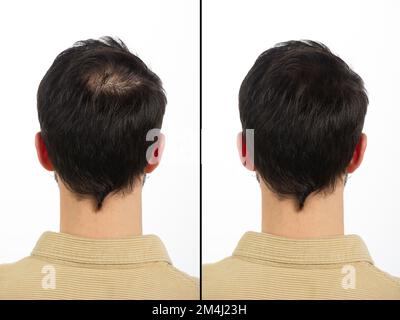 Testa vista da dietro che mostra la nuca di un giovane uomo con il principio di calvization prima e dopo il trattamento anti-perdita dei capelli. Concetto di perdita precoce dei capelli Foto Stock