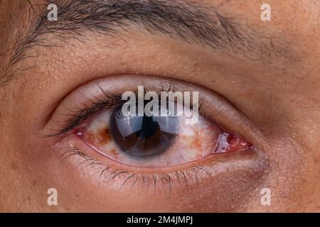 Macro di un occhio rosso affetto da congiuntivite, uno dei sintomi di infezione da covid-19 Foto Stock