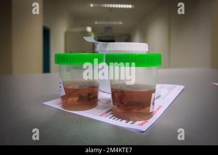I campioni di tessuto vengono posti in formalina per il successivo esame da parte di un patologo dell'ospedale Foto Stock