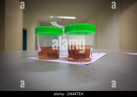 I campioni di tessuto vengono posti in formalina per il successivo esame da parte di un patologo dell'ospedale Foto Stock