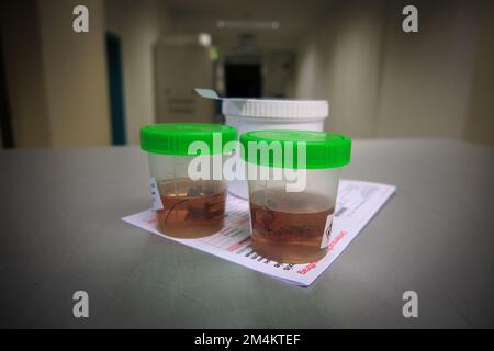 I campioni di tessuto vengono posti in formalina per il successivo esame da parte di un patologo dell'ospedale Foto Stock