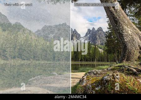 Simulazione visiva prima e dopo la rimozione della cataratta da un paziente con problemi di vista Foto Stock