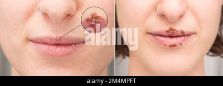 Primo piano delle labbra femminili con pustole e croste di Herpes Simplex. Macro con cerchio ingrandente che evidenzia la febbre labiale in dettaglio Foto Stock