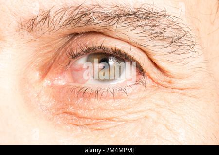 Macro dell'occhio di un anziano affetto da pterygium, una membrana triangolare alare che si verifica negli occhi che riduce la visione in diversi modi Foto Stock