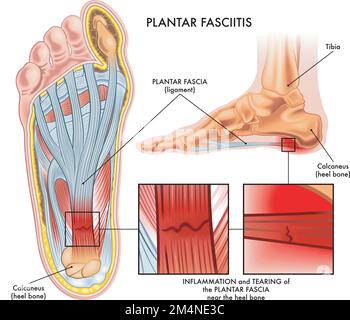 Illustrazione medica che mostra la sezione del piede con i sintomi di fasciite plantare con due dettagli ingranditi dei punti colpiti, e annotazioni. Illustrazione Vettoriale