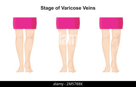 Fase di progettazione scientifica della vena varicosa. Simboli colorati. Illustrazione vettoriale. Illustrazione Vettoriale