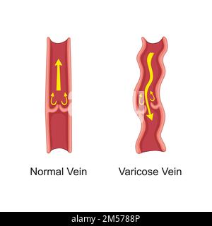 Disegno scientifico della vena varicosa. Simboli colorati. Illustrazione vettoriale. Illustrazione Vettoriale