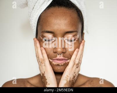 Ritratto di giovane donna brasiliana con vitiligo su viso e mani, primo piano dei dettagli della bocca, occhi chiusi e capelli ricci, sfondo bianco, copyspa Foto Stock