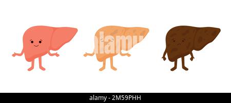 Un fegato sano. Steatosi epatica non alcolica. Cirrosi. Stadi reversibili e irreversibili di malattie epatiche. Illustrazione Vettoriale