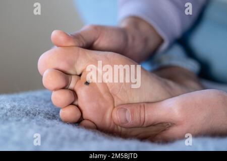 L'uomo controlla la verruca a casa dopo averla cauterizzata con la celandina a piedi. Verrucas papilloma callus virus Foto Stock