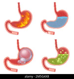 Vettore realistico vettore medico vettore illustrazione serie vettoriale. Pirosi disturbi del fuoco, reflusso acido gastrico, sfera addominale gonfiato, nausea liquido verde Illustrazione Vettoriale