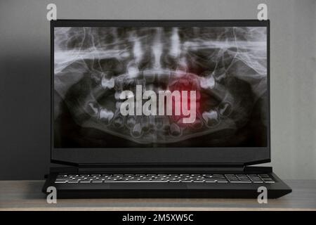 Raggi X panoramici dei denti dei bambini di due mascelle, ortopantomogramma dei denti dei bambini sugli schermi dei computer portatili sul tavolo Foto Stock