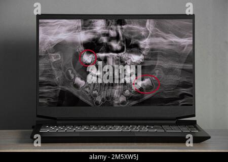 Raggi X panoramici dei denti dei bambini di due mascelle, ortopantomogramma dei denti dei bambini sugli schermi dei computer portatili sul tavolo Foto Stock