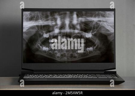 Raggi X panoramici dei denti dei bambini di due mascelle, ortopantomogramma dei denti dei bambini sugli schermi dei computer portatili sul tavolo Foto Stock
