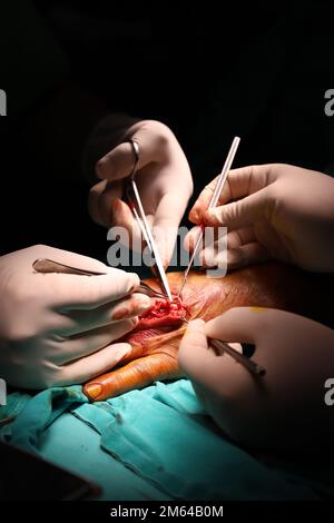 Trattamento della rottura del nervo e del vaso. Medico chirurgo di plastica tratta la mano facendo microchirurgia Foto Stock