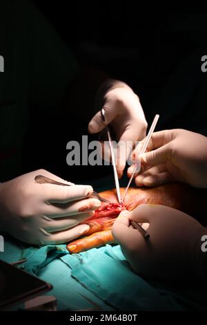 Trattamento della rottura del nervo e del vaso. Medico chirurgo di plastica tratta la mano facendo microchirurgia Foto Stock