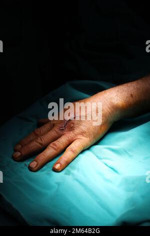 Trattamento della rottura del nervo e del vaso. Medico chirurgo di plastica tratta la mano facendo microchirurgia Foto Stock