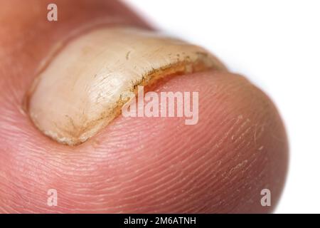 Unghia del piede con psoriasi e unghie sane del piede, unghie psoriasiche, primo piano Foto Stock