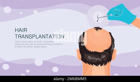 Perdita di capelli. Fasi di alopecia uomo problema vettore medico salute illustrazione trapianto di capelli Illustrazione Vettoriale