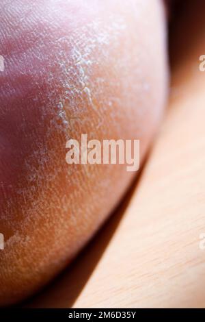 Immagine closeup di un tallone sul piede con un callo bianco. Foto Stock