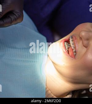 Una donna a un dentista per sostituire archi con bretelle. Foto Stock