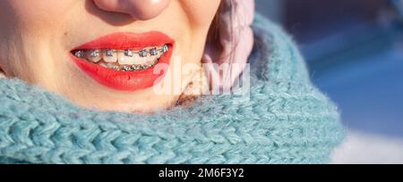 Ragazza sulla strada sorrisi e bretelle sono visibili sui suoi denti Foto Stock