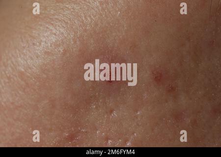 Primo piano estremo della struttura della pelle umana problematica con i pori aperti grandi-osservanti e le cicatrici dell'acne Foto Stock