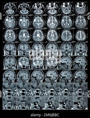 Risultati di scansioni cerebrali RM o immagini di risonanza magnetica, concetto di neurologia Foto Stock