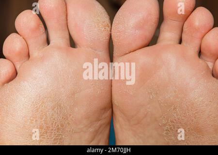 Pelle danneggiata sui piedi Foto Stock