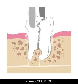 Rimozione del dente molare schiantato nella mandibola. Estrazione chirurgica di un dente rotto. Illustrazione medica in stile piatto. Illustrazione Vettoriale