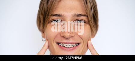 Giovane donna bionda dai capelli corti sorridente denti bianchi con bretelle dentali primo piano ritratto corto. Foto Stock