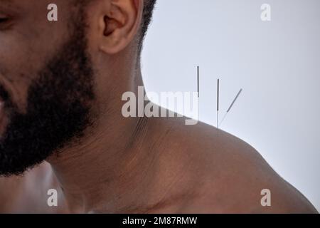 terapia agopuntura sulle spalle della schiena per il cliente nero. giovane uomo corto sottoposto a trattamento agopuntura con una linea di aghi sottili inseriti Foto Stock
