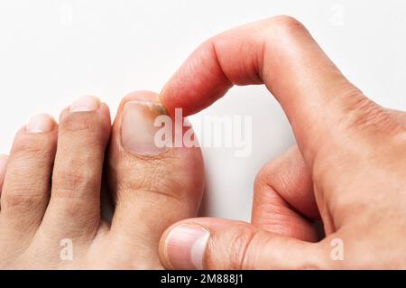 Uomo adulto che graffia la punta con il fungo su asciugamano bianco quando lascia la piscina Foto Stock